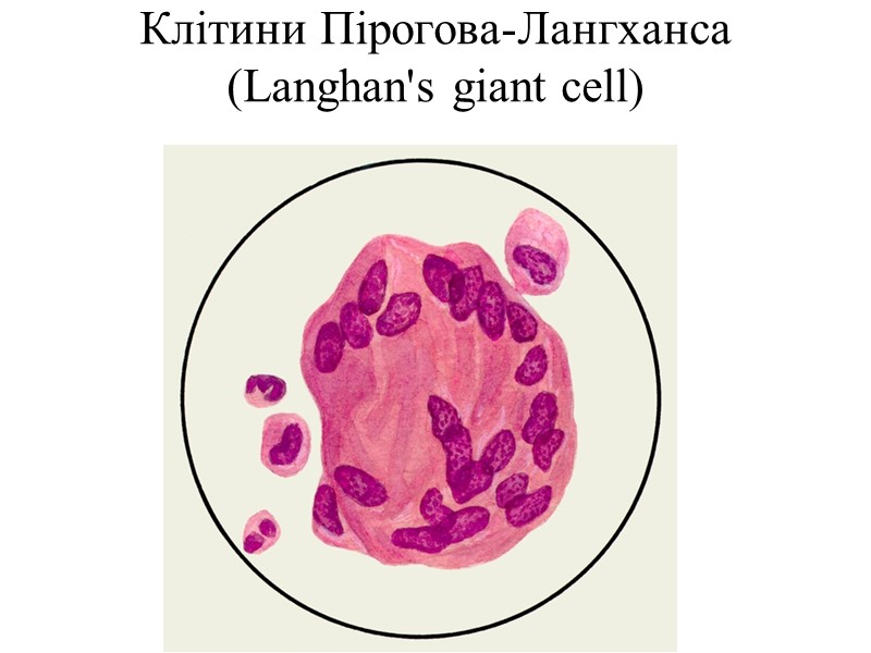 Клітини Пірогова-Лангханса (Langhan's giant cell)